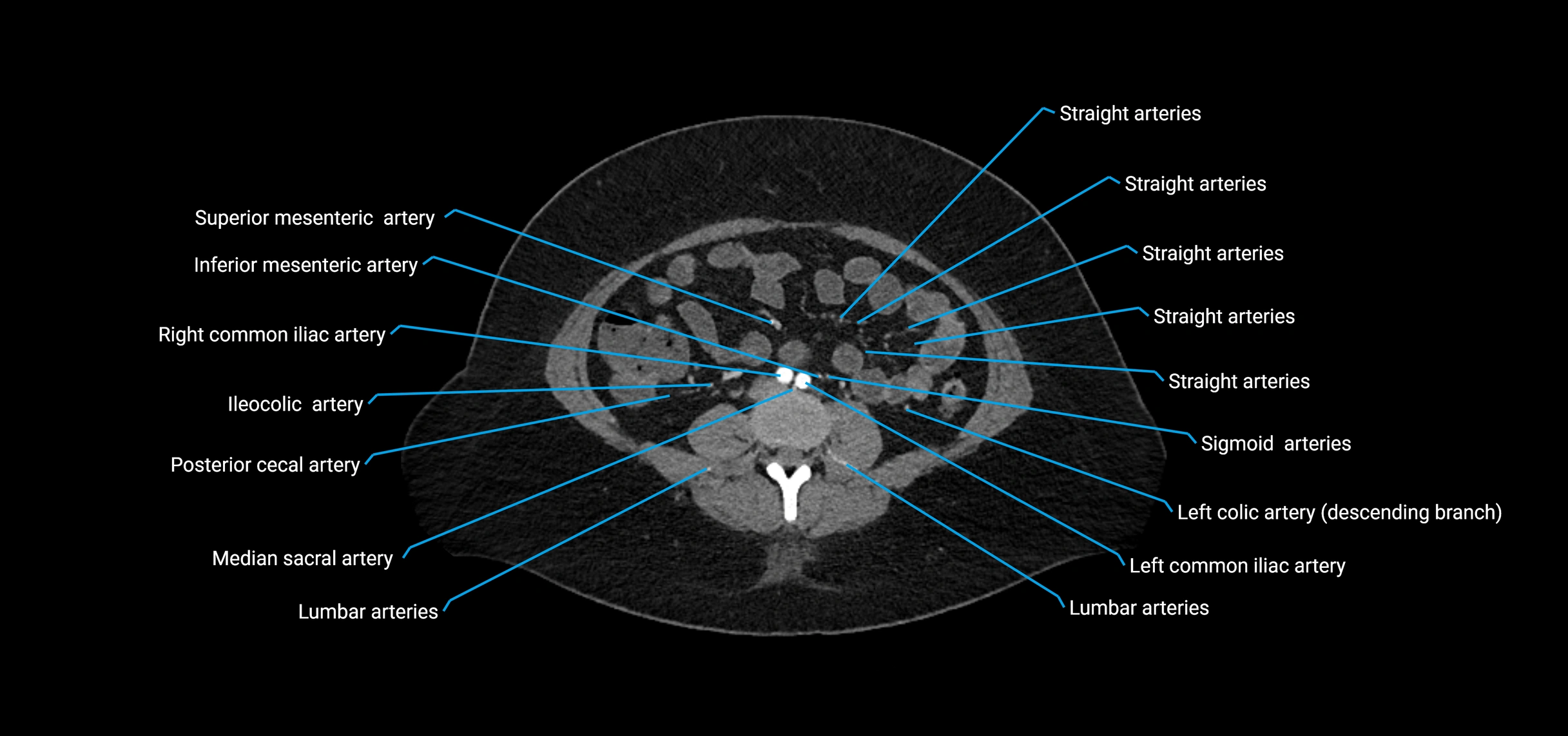 CTA abdomen axial cross sectional anatomy labelled image_127 (2).webp